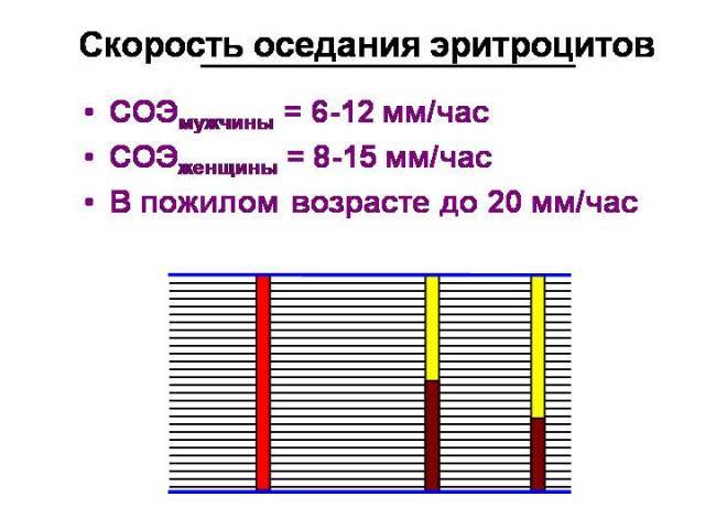 СОЭ – норма в крови у женщин, причины повышения