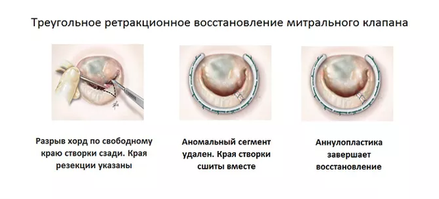 Пролапс митрального клапана – что это, чем опасен?