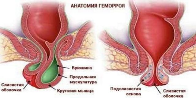 Свечи от геморроя - недорогие и эффективные при кровотечении