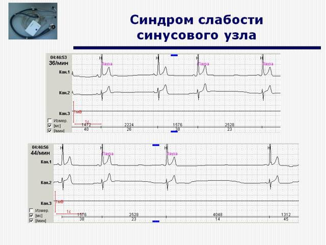 ЭКГ при синдроме слабости синусового узла (СССУ)