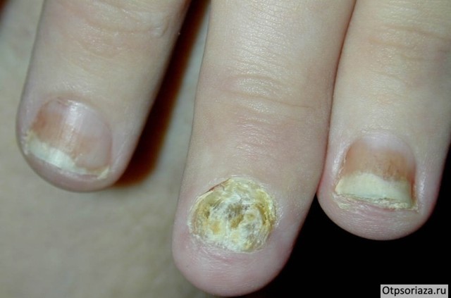 Лечение псориаз на руках - фото, симптомы, виды псориаза на руках
