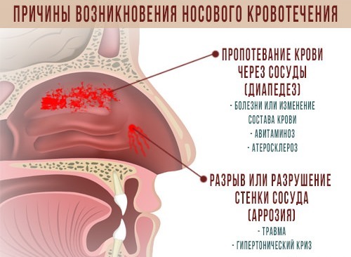 Кровь из носа: возможные причины, первая помощь и лечение