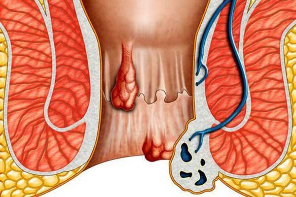 Свечи от внутреннего геморроя