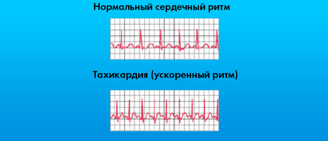 Картинки ЭКГ при нарушениях ритма