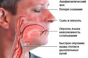 Аллергия на пыль у ребенка: симптомы, причины, лечение