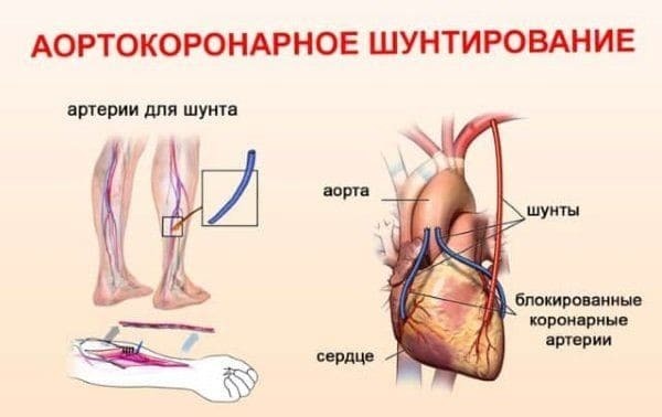 АКШ (аортокоронарное шунтирование): открытая операция на сердце при атеросклерозе