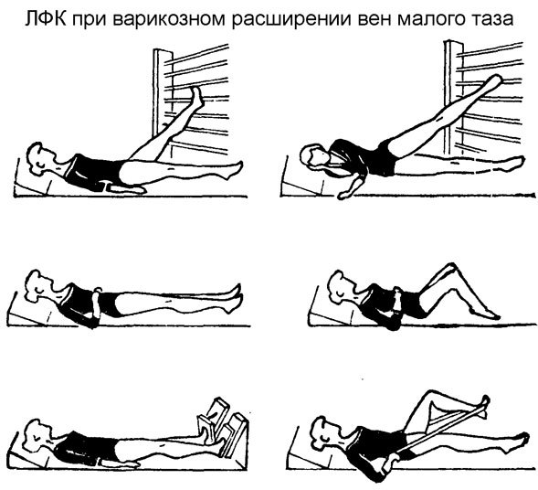 Варикозное расширение вен малого таза у женщин