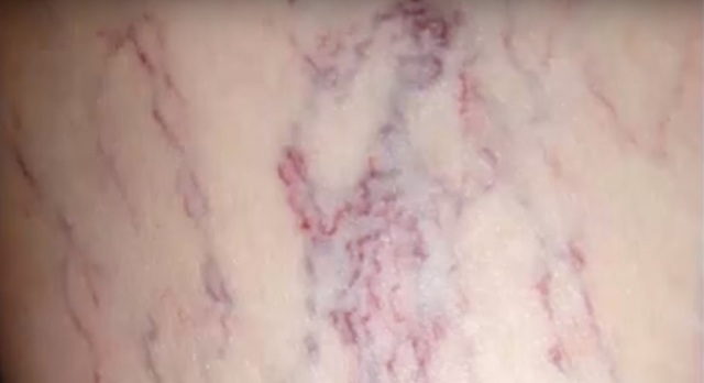 Яблочный уксус при варикозе: как и зачем принимать?