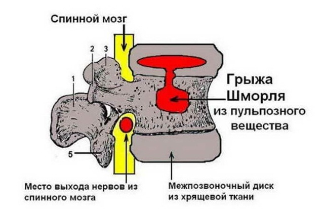 Грыжа Шморля поясничного отдела позвоночника, лечение и симптомы