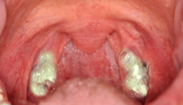 ЛИМФОЦИТЫ В КРОВИ У РЕБЕНКА ПОВЫШЕНЫ: [причины, лечение]