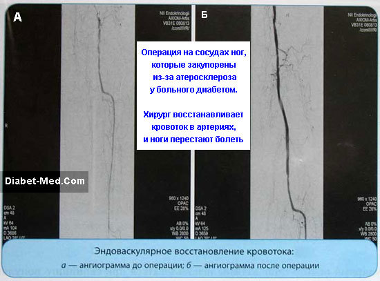 Как диабет влияет на ноги?