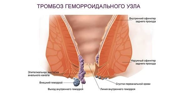 Тромбоз наружного геморроидального узла: причины и лечение