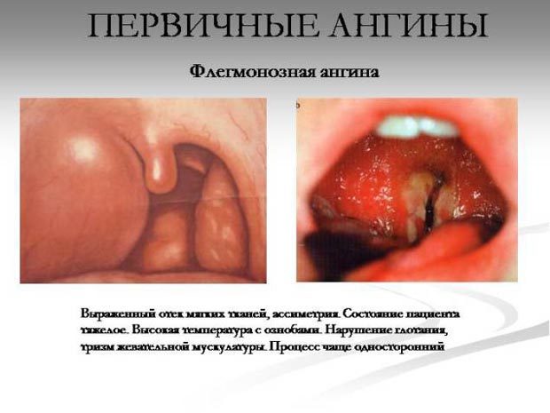Тонзиллит: виды, фото, лечение и симптомы