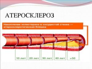 Экстравазальная компрессия позвоночной артерии