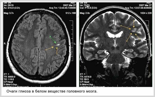 Глиоз головного мозга, что это такое, прогноз жизни, очаги в белом веществе