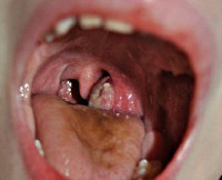 Паратонзиллярный абсцесс: лечение, фото, симптомы