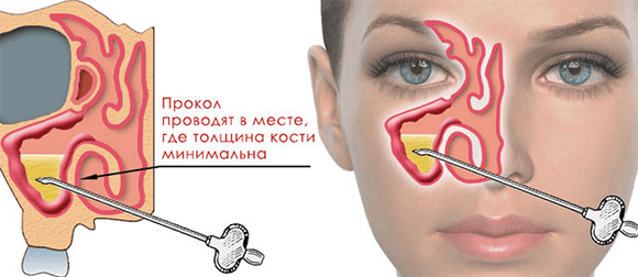 Прокол носа при гайморите - как делают и что ожидать