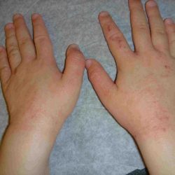 Лечение псориаз на руках - фото, симптомы, виды псориаза на руках