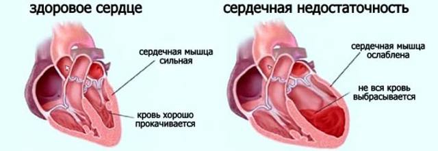 Ингибиторы АПФ: список препаратов при гипертонии. Ингибиторы АПФ – что это такое?