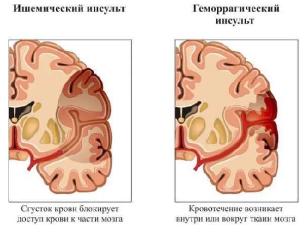 Инсульт левая или правая сторона, последствия, сколько живут