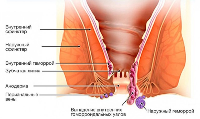 Глицериновые свечи после родов со швами. Применение глицериновых свеч после родов