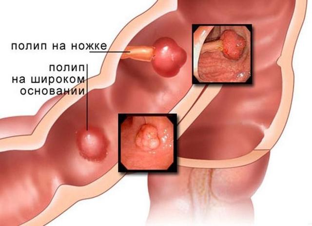 Зуд в заднем проходе у женщин: причины появления, лечение