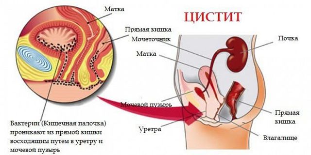 Фуросемид раствор для инъекций: инструкция к применению и аналоги