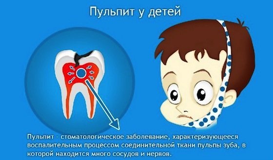 Пульпит зуба: симптомы, причины, лечение
