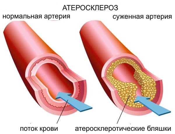 Атеросклероз сосудов головного мозга - лечение, симптомы