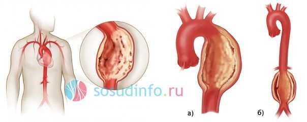 Уплотнение аорты – причины, симптомы, осложнения и лечение уплотнения аорты
