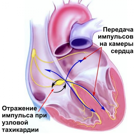 Тахикардия - причины, признаки, симптомы и лечение