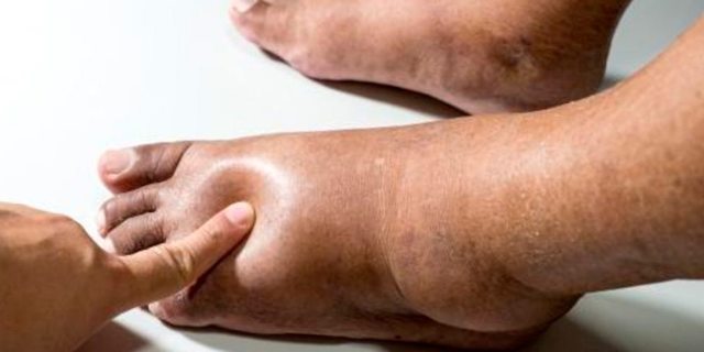 Отеки при сердечной недостаточности: симптомы, патогенез, лечение