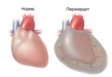 Что означает скорость оседания эритроцитов повышена и причины этого