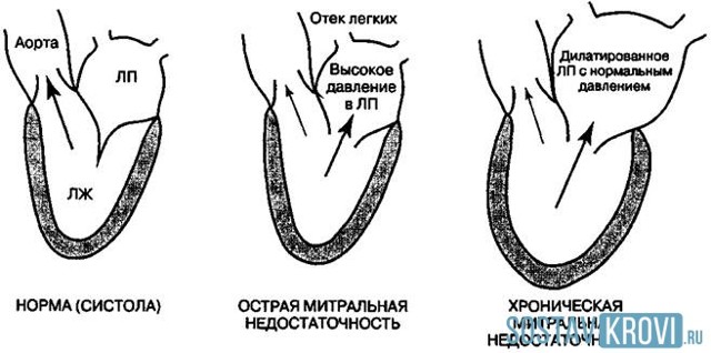 Регургитация 1 степени что это такое - Всё о сердце