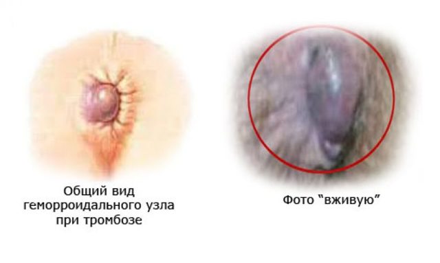 Тромбоз наружного геморроидального узла: причины и лечение