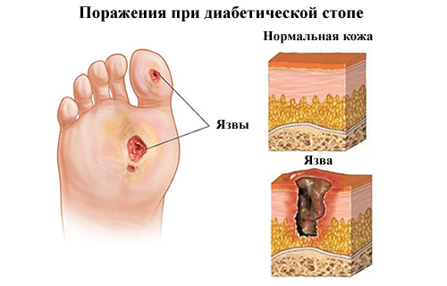 Диабетическая дистальная полинейропатия: симптомы и диагностика. Лечение диабетической полинейропатии в Москве