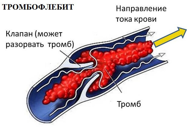 Аналоги препарата Гепарин