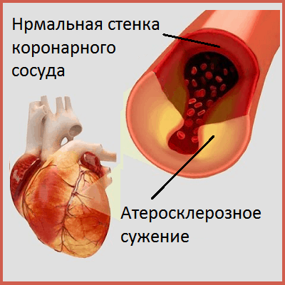 В каком месте и как болит сердце: признаки и симптомы