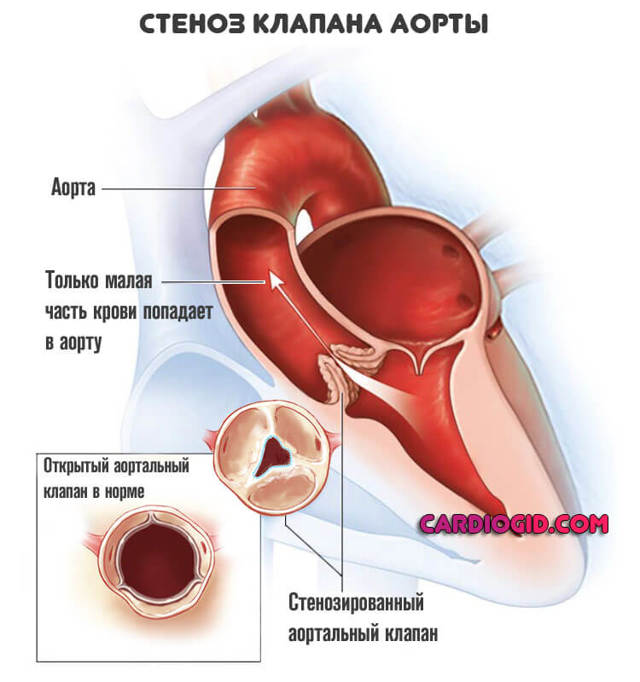 Стеноз аорты: симптомы и медикаментозное лечение