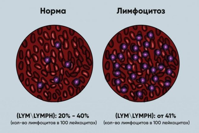 Лимфоциты в крови повышены: причины у женщин цимфацитоза