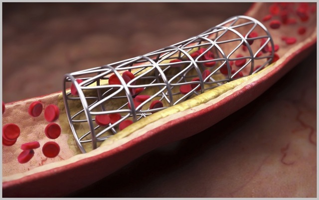 Операция по чистке сосудов нижних конечностей
