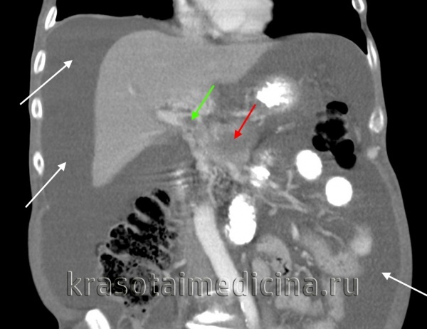 Билиарная гипертензия печени: симптомы, признаки на УЗИ и лечение синдрома