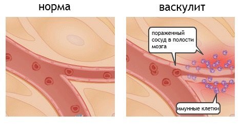 Васкулит - симптомы, причины и лечение ( фото)