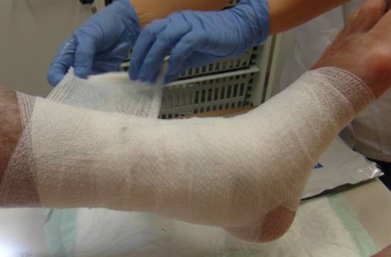 Варикозное расширение вен чем опасно на сайте варикоз