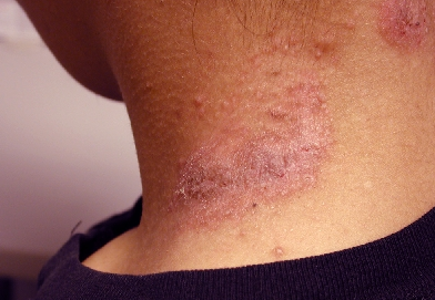 Нейродермит у взрослых и детей: симптомы (фото), лечение
