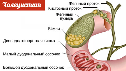 Боль в грудине: причины болевых ощущений слева, справа и посередине грудной клетки (видео)