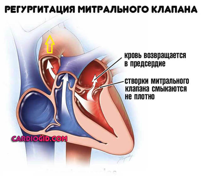 Асистолия сердца - что это такое, симптомы