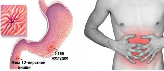 Операция на двенадцатиперстной кишке последствия. Прободная язва двенадцатиперстной кишки: диета после операции. Лечение желудочной язвы