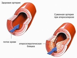 Уплотнение аорты - что это такое и как проявляется патология