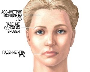 Транзиторная ишемическая атака - за шаг до инсульта.